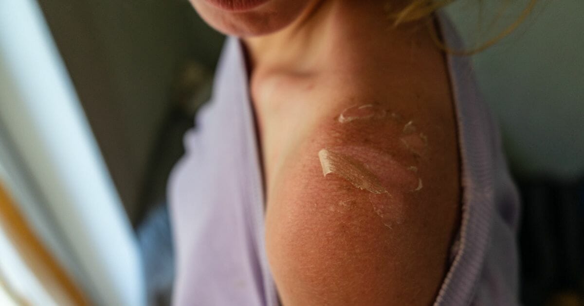 Com evitare che la pelle si spelli dopo il sole