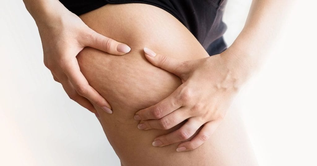 ragazza stringe la pelle delle cosce e si vede la cellulite e si chiede cosa è più efficace per la cellulite
